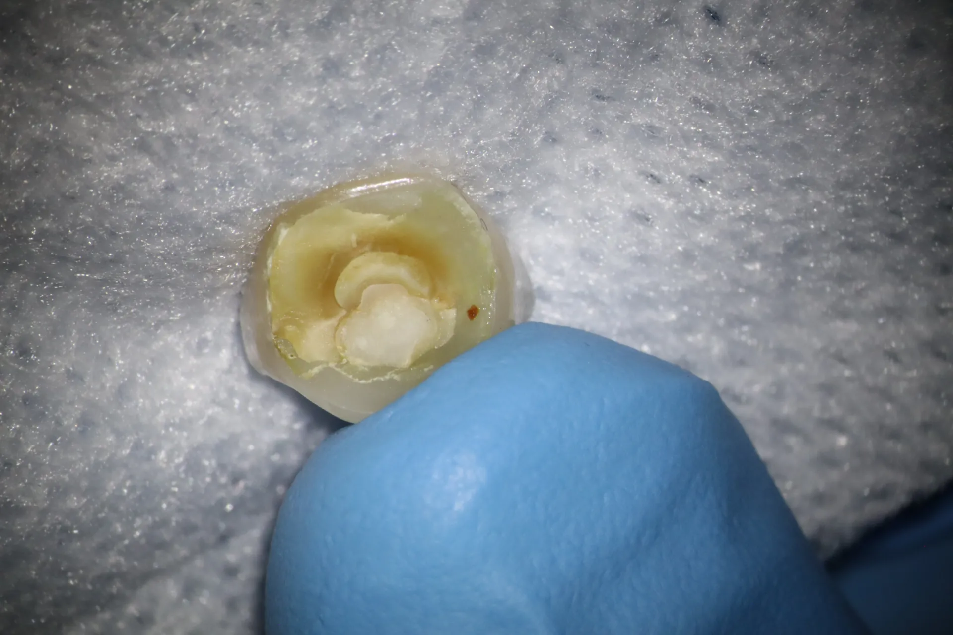 Removed fractured tooth segment showing extent of structural compromise